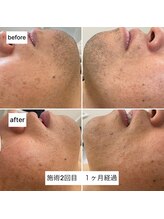 ラウラウ(laulau)/ヒゲ脱毛