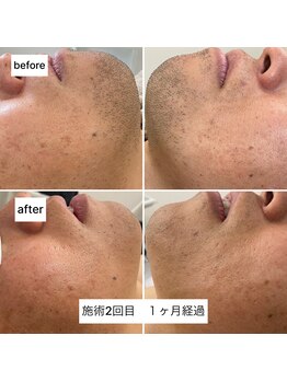 ラウラウ(laulau)/ヒゲ脱毛