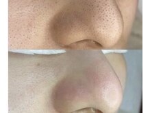 ビューティクリニック フリープ(beauty clinic freep)の雰囲気（大人気毛穴洗浄&水素ピーリング）