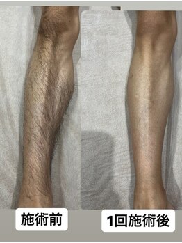 るあん/美肌脱毛