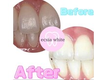 エクシアホワイトニング 明石店/ホワイトニング体験/記念写真