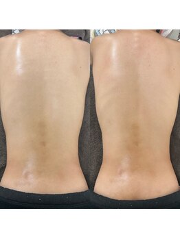 リンデザ(Lindeza)/ウエストスッキリ