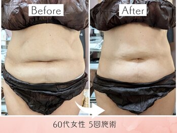 ラグーン(Lagoon)/WINBACK×筋膜リリース