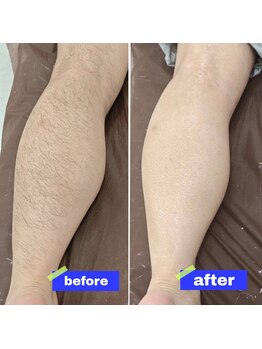 アルマサロン 菊陽(Almasalon)/両ひざ＋ふくらはぎWAX脱毛