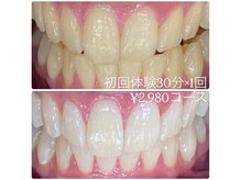 ホワイトニングルーム 川崎店(WhiteningRoom)/ホワイトニング/川崎
