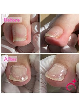 Dr.巻き爪 札幌北一条東院/見た目を綺麗に♪