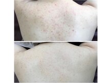 ココ 梅田中津(COCO.)/背中＊ハーブピーリング