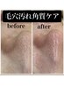 【毛穴特化】いちご毛穴が3ヶ月で毛穴レスな肌へ　ハイドロ毛穴洗浄　