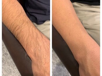 ルルトウキョウ 池袋店(LULU.tokyo)/ヒジ下脱毛/1回目→6回目