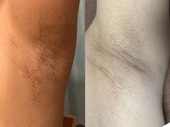 リボーン(REBORN)/メンズ脱毛