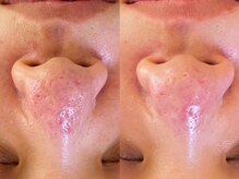 小顔フェイスラボ 鈴鹿店(小顔FaceLabo.)/◆毛穴・凸凹改善◆