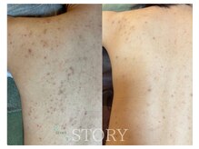 ストーリー(STORY)/ハーブピーリング専門店STORY