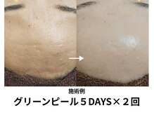 エメ(Eme)の雰囲気（ほうれい線・たるみ・しわの改善に！肌がぐっと持ち上がります）