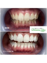 ホワイトニングサロン 名古屋駅店/【ホワイトニング施術例】