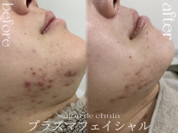サロンドチュラ(salon de chula)/プラズマ/ニキビケア/肌質改善