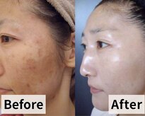 フェイスプラスリフ(FACE+RiF)