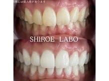 シロエラボ 梅田店/白い歯で好感度アップ！