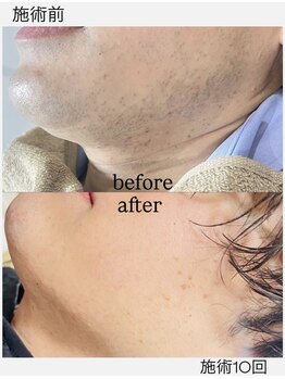 ケープラス(K Plus+)の写真/《メンズまゆ毛&ひげ脱毛専門店》イケメンは髭脱毛&眉毛ケアは当たり前!![髭脱毛¥4000/アイブロウ¥3500] 