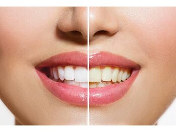 ビューティクリニック フリープ(beauty clinic freep)/歯のホワイトニング