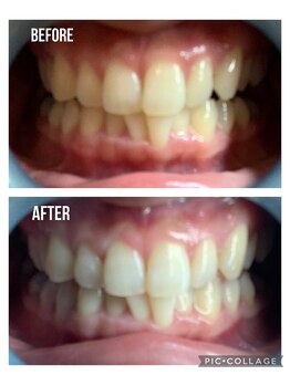 ロア(ROA)/セルフホワイトニング