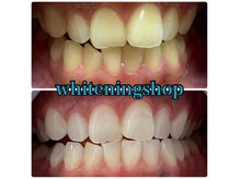 ホワイトニングショップ 天王寺店/40分照射×10回 20代女性