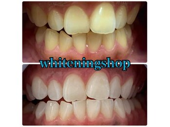 ホワイトニングショップ 天王寺店/40分照射×10回 20代女性