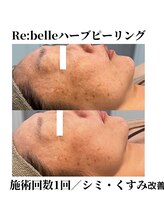 サラ/Re:belleハーブピーリング