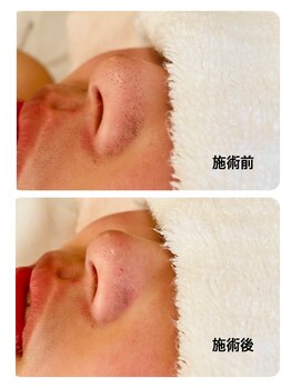 コストマリー/水素ピーリングで毛穴黒ずみ解消