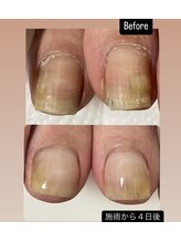 アールネイルズ(R Nails)/巻き爪の方必見！！