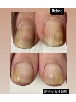 アールネイルズ(R Nails)/巻き爪の方必見!!
