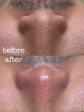 ピエル 柏店(PIEL)/毛穴エクストラクション