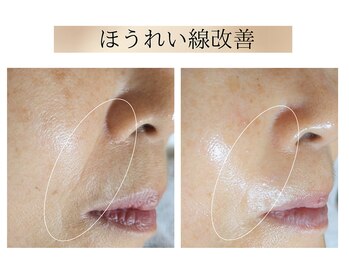 エボルブ 四条烏丸店(EVOLVE)/ほうれい線改善！