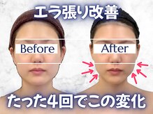 パッパ(PAPPA)の雰囲気(エラ張りは発達しすぎた咬筋が原因大/緩めて整える/18歳以上限定)