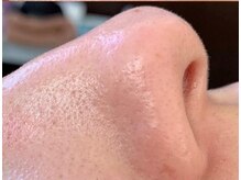 トータルビューティーエステサロン サクラ(SAKURA)/☆EIEN☆過熱水蒸気式スチーマー