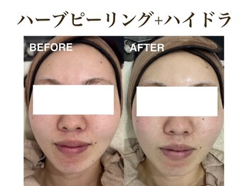 ティアム バイ テトテ 神戸三宮(TIAM by tetote)/ハーブピーリング+毛穴洗浄