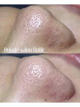 ルチル(Rutile)/韓国式3D毛穴洗浄