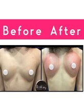 エルフラージュ 銀座店/Ｅカップ→Ｇカップ４センチUP