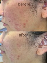 アンフェリエ(Un Feerie)/プラズマ施術