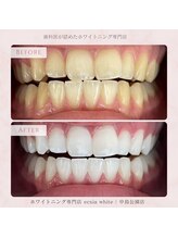 エクシアホワイトニング 札幌中島公園店/Before After［ホワイトニング］