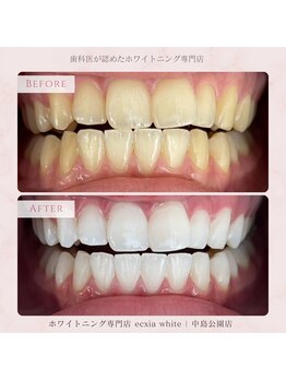 エクシアホワイトニング 札幌中島公園店/Before After［ホワイトニング］