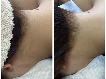 ルルトウキョウ 池袋店(LULU.tokyo)/うなじ脱毛/1回目→3回目