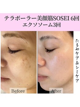 癒える(ielu)/テラボーラー ＆エクソソーム