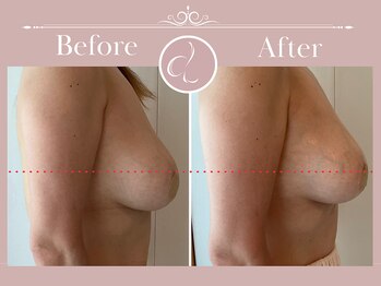 美バストアルファ(美bust α)/【バストアップ】症例