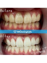 ホワイトニングカフェ 三島店/★Before→ After