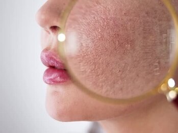 エステサロン ベリシモ(Bellissimo)の写真/【毛穴洗浄×韓国肌管理】最新AI診断で原因特定!ララピール&LDMで黒ずみ・開きを徹底改善し水光肌へ