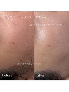 ブルーム(bloom.)の写真/【剥離なしハーブ×純日本製WAX】毛穴汚れ・産毛をオフして内側から発光！韓国美人のような陶器肌へ。