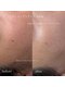 ブルーム(bloom.)の写真/【剥離なしハーブ×純日本製WAX】毛穴汚れ・産毛をオフして内側から発光！韓国美人のような陶器肌へ。