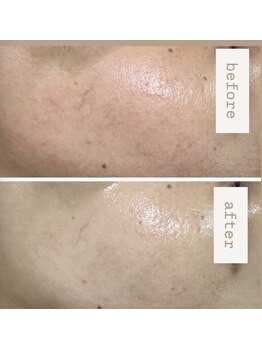 シュクル(sucre)の写真/全ての肌悩みをカスタムメイドで肌管理。透明感とうる艶肌へ。納得の結果♪