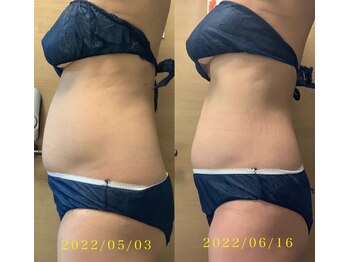 ビーバイビー(BBYB)/当店の痩身モニター様 実例