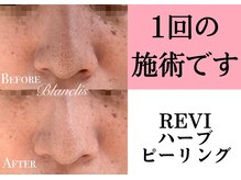 ブランリス(Blanclis)の雰囲気（REVI正規代理店だからこその効果！毛穴の汚れ開きもお任せ下さい）